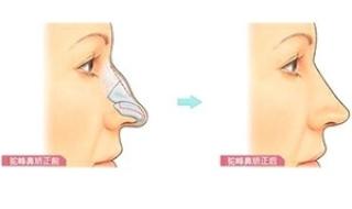 驼峰鼻价格 驼峰鼻价格